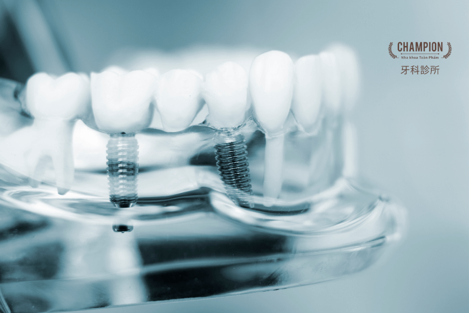 “Cấy ghép răng toàn hàm” là gì?